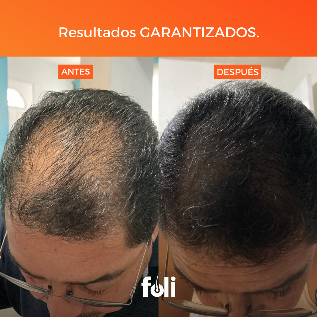 foli™️ | Crecimiento de Cabello | 90 días