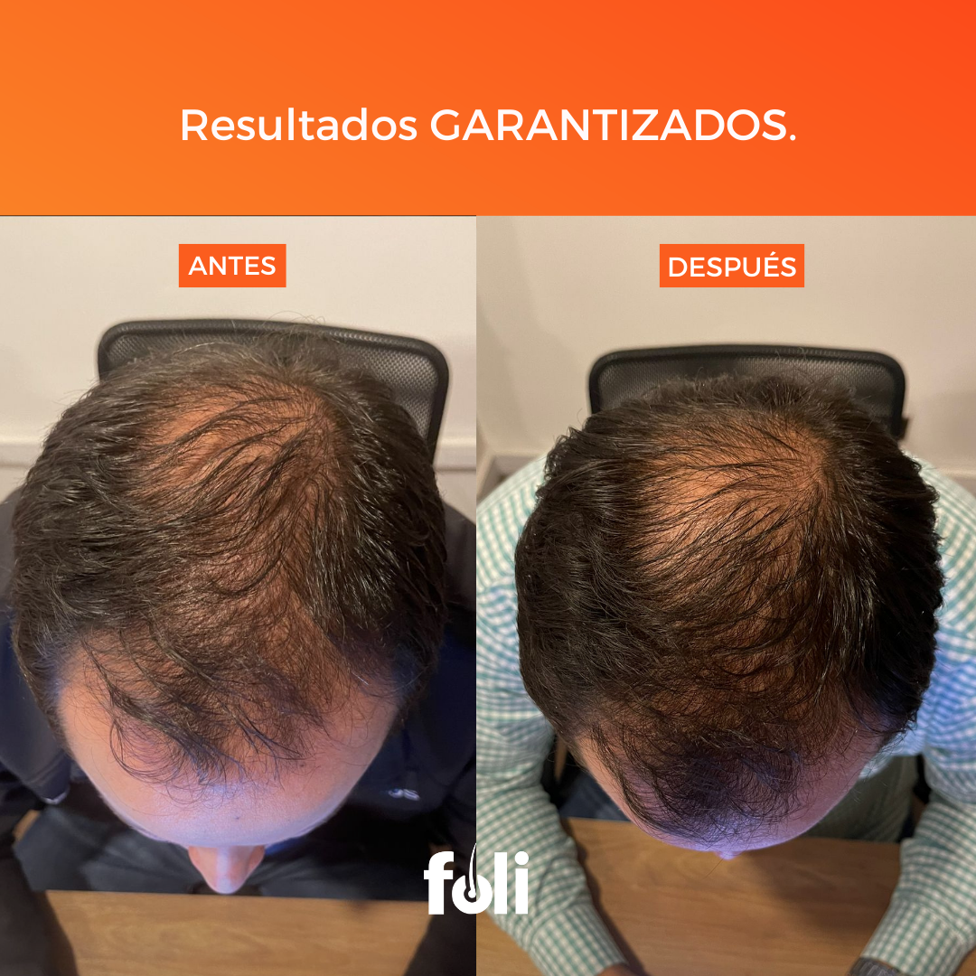foli™️ | Crecimiento de Cabello | 90 días