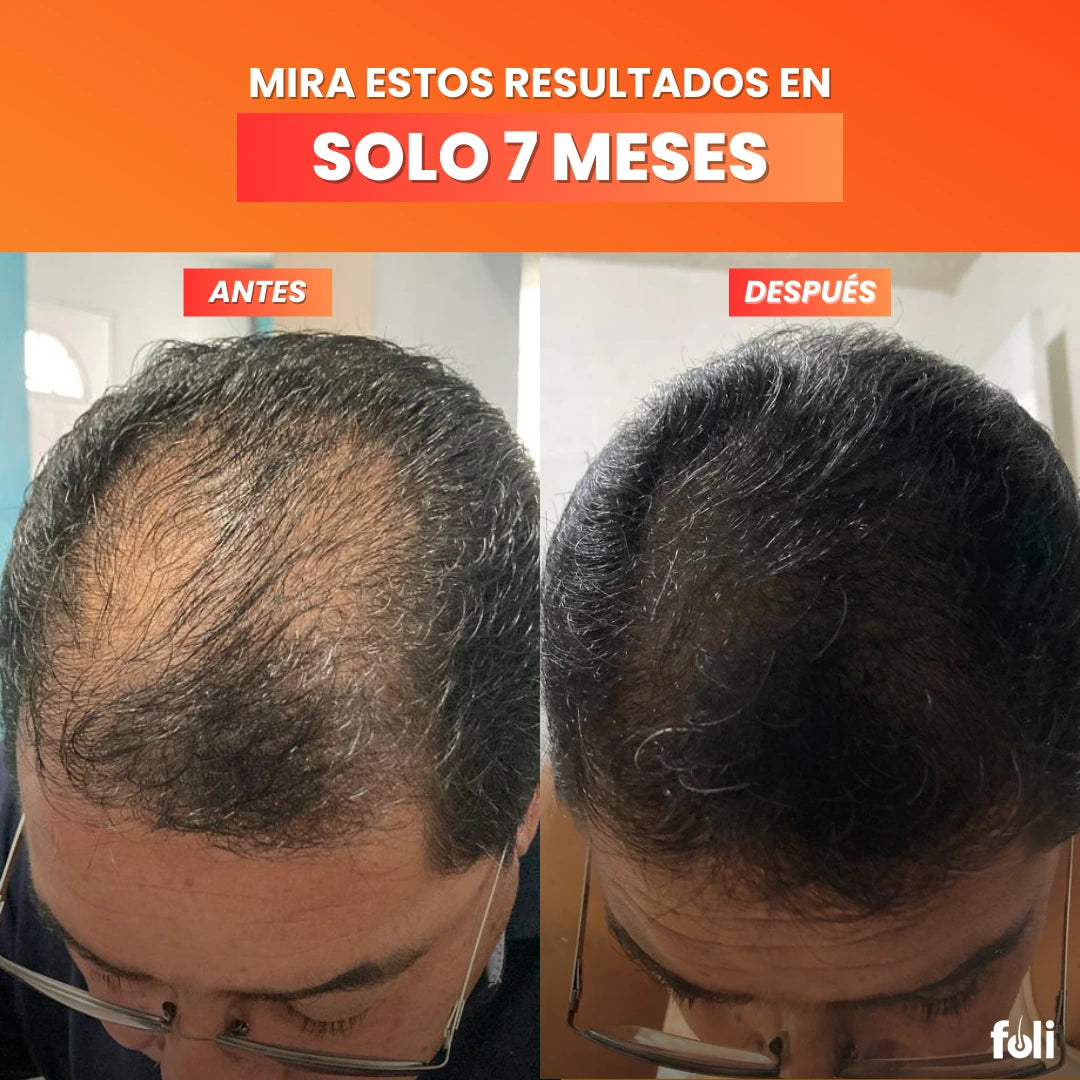 foli™️| Suplemento para Crecimiento de Cabello | 90 días por bolsa