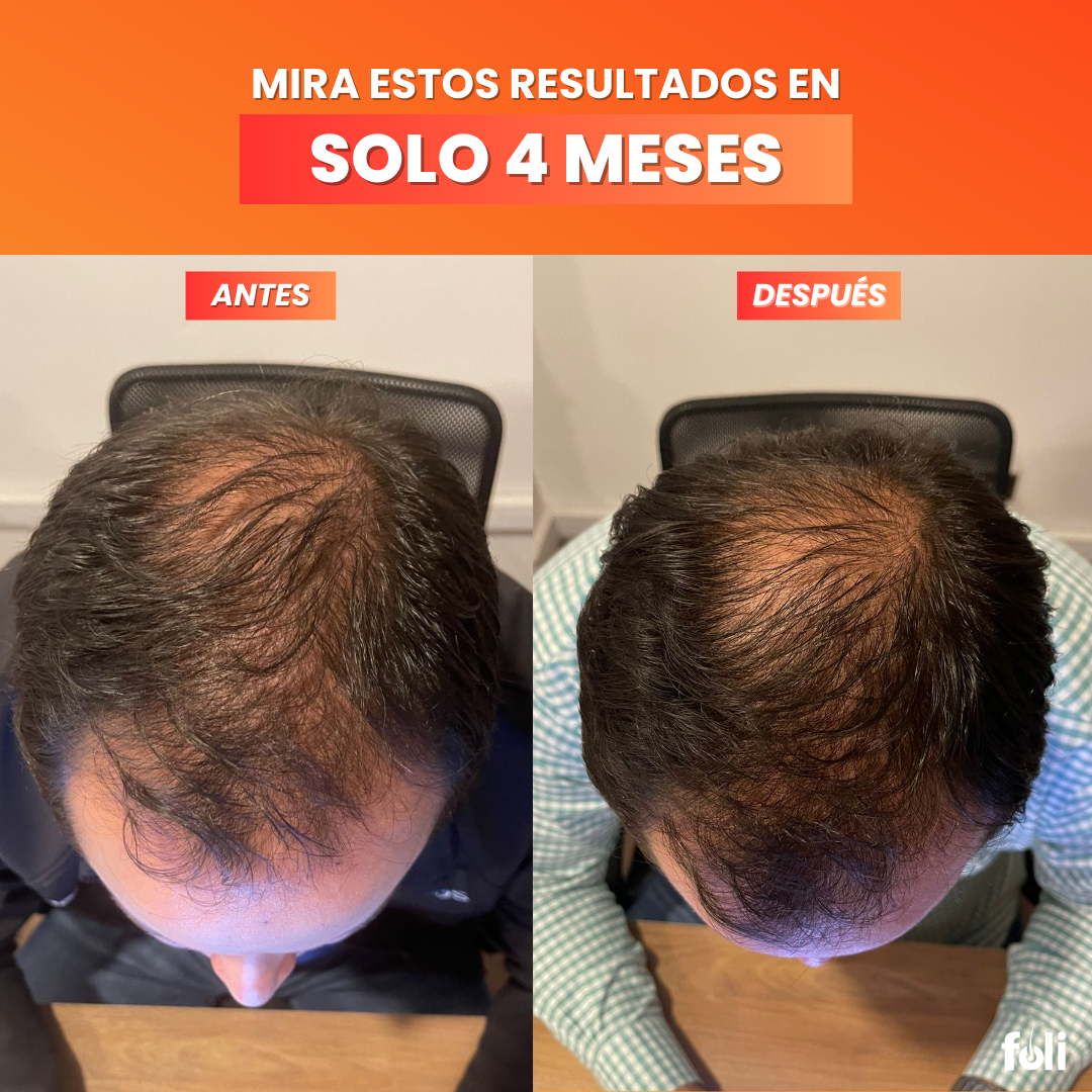 foli™️| Suplemento para Crecimiento de Cabello | 90 días por bolsa